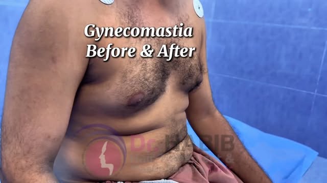 Gynecomastia before & after 1 week result 💯🌟
.

For booking\more details:0️⃣3️⃣2️⃣5️⃣8️⃣8️⃣0️⃣0️⃣3