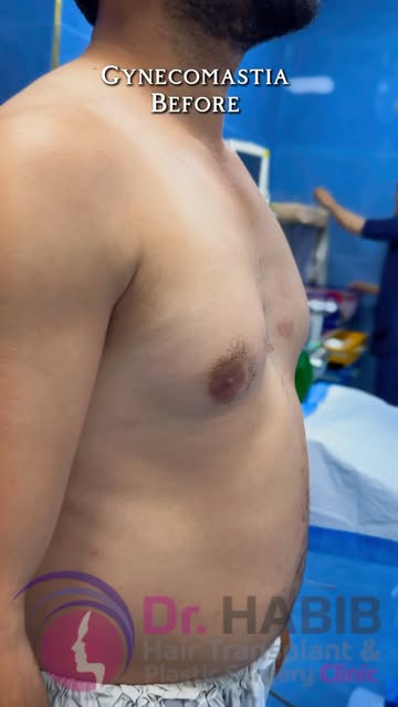 Watch this Gynecomastia before & after result🤩. Performed by Dr Habib 👨🏻‍⚕️😎.
.

For booking\mor
