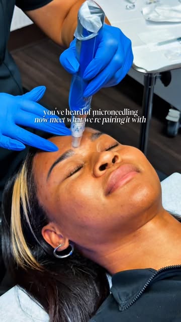 What happens when microneedling meets peptides + growth factors? ✨

You get a treatment pairing desi
