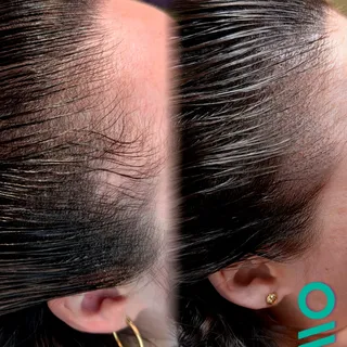 Hairline glow up!! ✨✨✨ 

#smp #scalpmicropigmentation #femalesmp #hairline