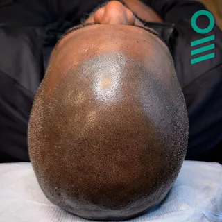 2025 vs 2020. SMP Flux capacitor. 🙌🏼🧬

#smp #smpbc #scalpmicropigmentation #scalpmicropigmentatio