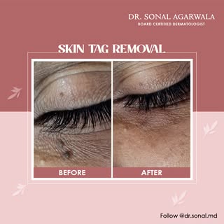Transform your skin with our gentle and effective skin tag removal treatment. See the remarkable bef