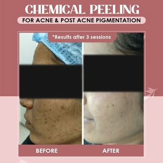 Is acne leaving its mark on your skin? Achieve clearer skin with our specialized Chemical Peeling th