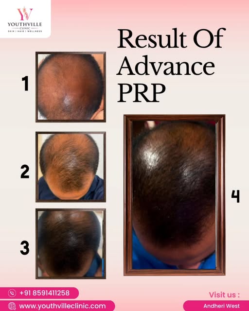 ✨ Healthy Hair Starts at the Root! ✨

Advanced PRP helps support the scalp’s natural healing process