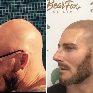 Sick of having to shave your head every day?
 SMP gives u the look of a full head of hair that you h