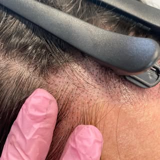 Nice little start to a second session for density work on a old hair transplant that didn’t give the