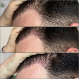 Want to add density to your hair transplant⁉️ did you know that having #smp after a hair transplant 