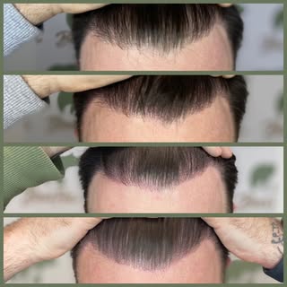 The brief.. Natural looking hairline but with more definition and fuller looking!

Nailed it!!

Anot