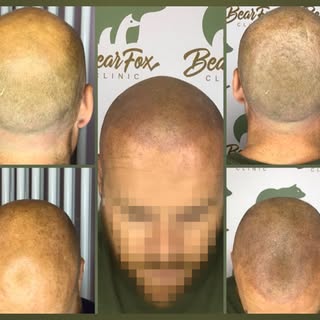 Change your life, change your hairline
The revolutionary scalp micropigmentation is a total game cha