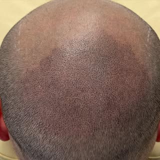 Nice little top up session to start the day off #smp #scalpmicropigmentation #goingbald #hairrestora