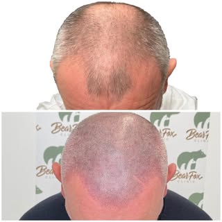 Thinning hair…. No problem let us boost your confidence!!
Get in touch today for a free quotation!!

