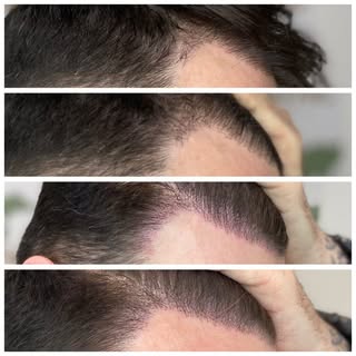 🚨 THIS ISN’T A FILTER.
THIS ISN’T A HAIR TRANSPLANT. 🚨

This is Scalp Micropigmentation (SMP) — an