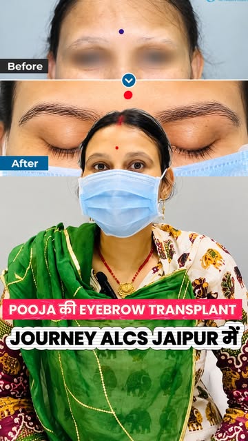 DNC के बाद खोई Eyebrows… फिर वापस आया Confidence! ✨
पूजा की Eyebrow Transplant Journey at ALCS Jaipu