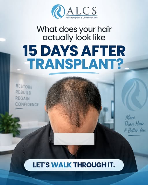What Does Hair Look Like 15 Days After a Hair Transplant? 👀

A hair transplant is a journey—not an 