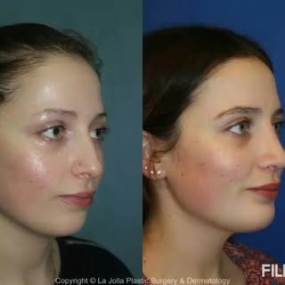 Doctor Richard Chaffoo,MD
Simply the best 
.
#rhinoplasty #nosejob #plasticsurgery #rinoplastia #i #