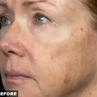 Discover the remarkable outcomes of Fraxel laser treatment, skillfully performed by Dr. Chaffoo. Ele