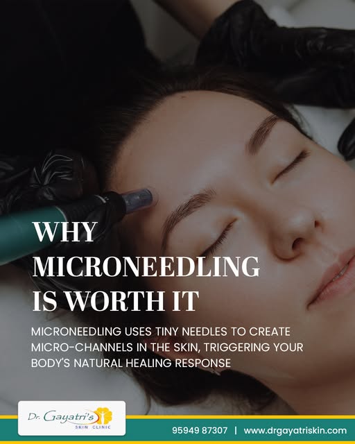 Microneedling stimulates your skin’s natural healing process, helping improve texture, collagen prod