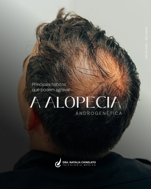 A alopecia androgenética tem origem genética e hormonal, mas alguns hábitos do dia a dia podem acele