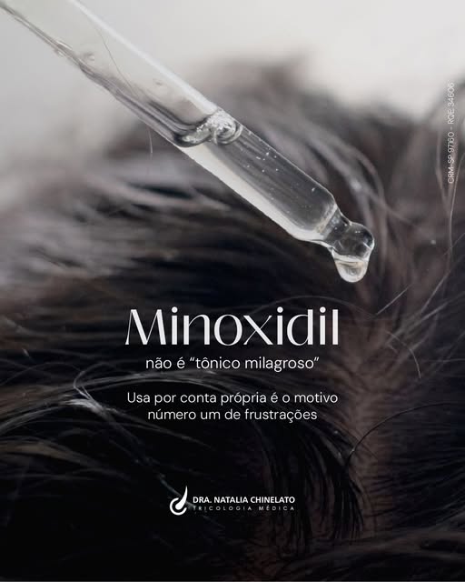 O minoxidil é um dos tratamentos mais eficazes e estudados para queda de cabelo, mas ele não funcion