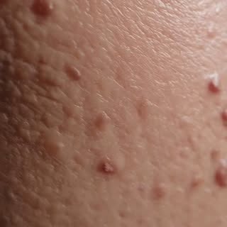 Akne, her yaşta görülebilen yağ bezlerinin kronik bir hastalığıdır.

Yanlış inanışlara kulak asmayın