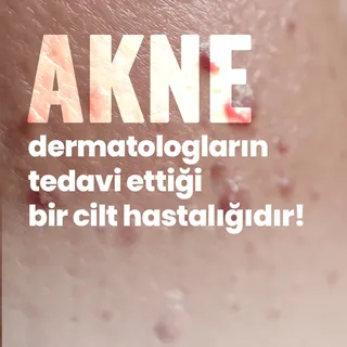Akne, her yaşta görülebilen yağ bezlerinin kronik bir hastalığıdır.

Yanlış inanışlara kulak asmayın