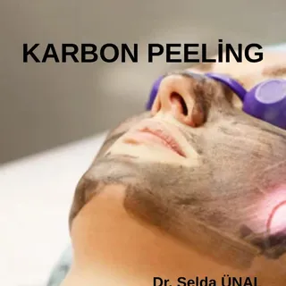 KARBON PEELİNG;  deriye karbon içeren bir solüsyon sürülmesini takiben lazer ışını ile bu karbon par
