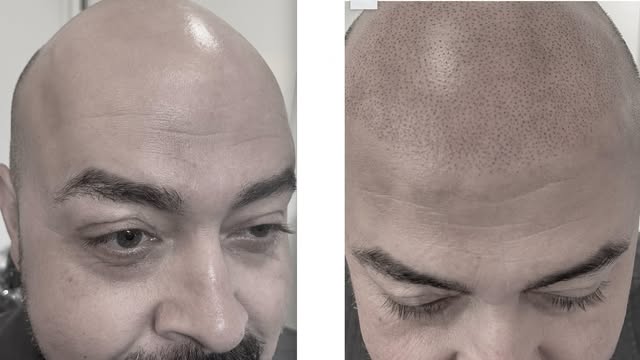 Ready to ditch the hats and bring back a clean, full-head buzz cut look? 👊

Full scalp Scalp Microp