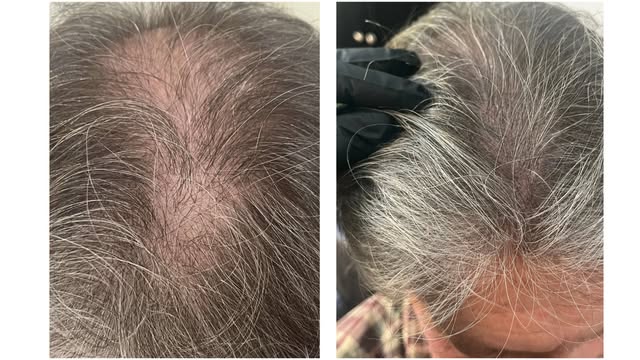 Age is mandatory, but thinning hair doesn't have to be. 

No daily concealers, no styling tricks, ju