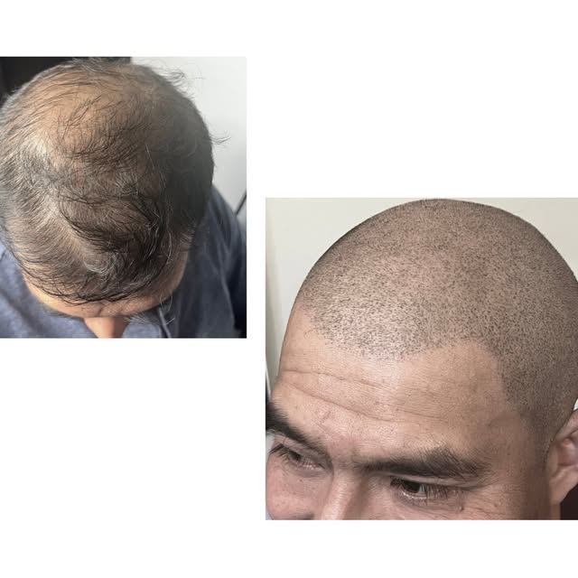 The Buzz Down: The artist shaves your head to a #0 or #1 guard to see your exact follicle pattern an