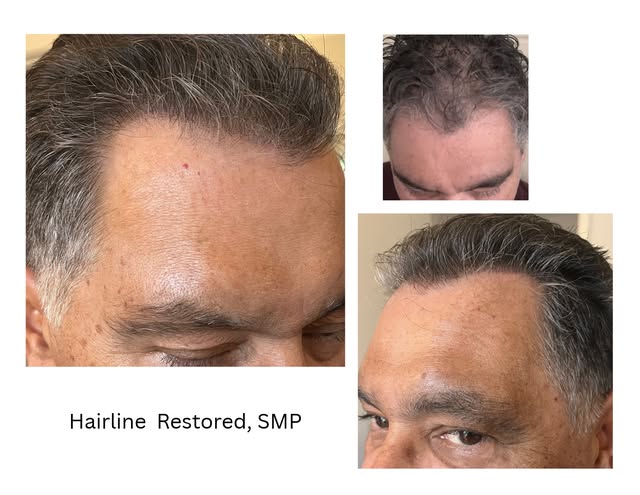 Restore your hairline  and your confidence. ✨
Take a look at this incredible transformation! I used 