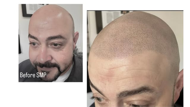 Here's Myke's precision buzz cut look using Scalp Micropigmentation Procedure (SMP), and the results