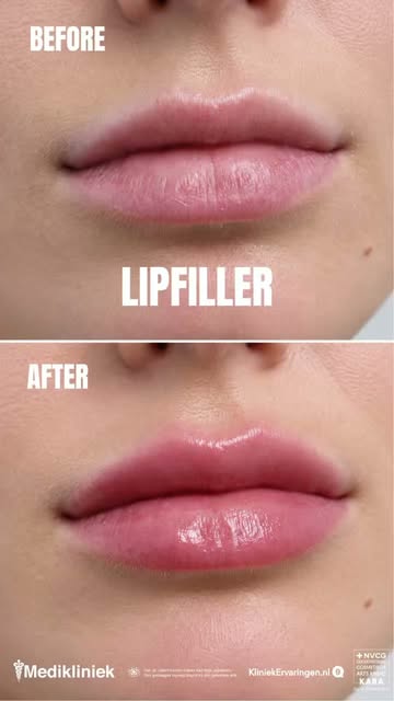 💋 Een subtiele verandering, een groot verschil.

Bij Medikliniek draait het niet om grotere lippen,