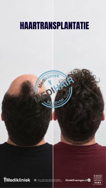 Van haarverlies naar een zichtbaar vollere haardos! 🌱✨

Deze before & after laat zien hoeveel versc