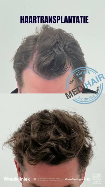 Een nieuwe haarlijn, een nieuw hoofdstuk. 

Soms zit het verschil in de details. Deze before & after