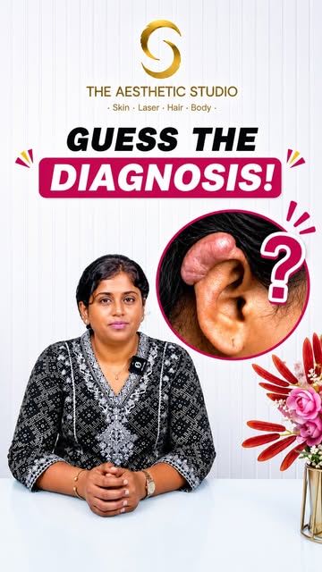 Lump on your ear? It could be an ear keloid.

Ear keloids are thick, raised scars that commonly deve