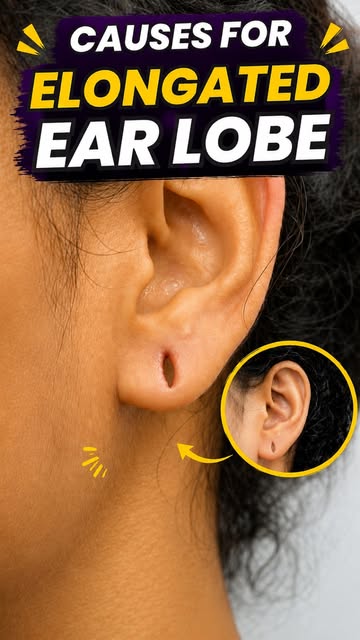 Why does your earlobe look stretched or elongated? 👂

Changes in the earlobe can happen for several