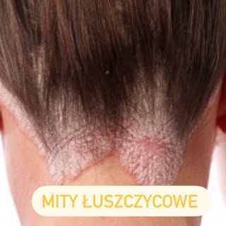 ❌Łuszczycą można się zarazić

 ✅Prawda: Łuszczyca nie jest chorobą zakaźną i nie można się nią zaraz