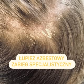 Czy wiesz, co to jest łupież azbestowy? 🤔

To rzadko spotykana forma łupieżu, która charakteryzuje 