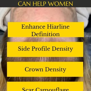 Scalp micropigmentation is a great option for women. 
SMP is :
✅ Low maintenance 
✅Cost Effective 
✅