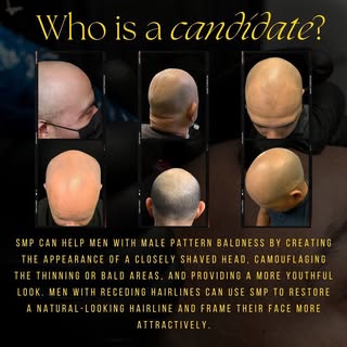 You still wearing that hat to hide your hair loss? In just 3 sessions we can give you the look of a 