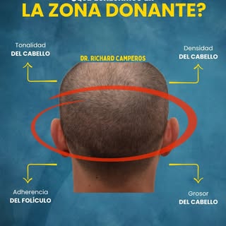 🎥 ¿Qué evaluamos en la zona donante antes de un trasplante capilar? 💇‍♂️🔍

1️⃣ Tonalidad del cabe