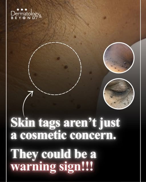 Noticed any skin tags on your neck, under arms or groin?

📍114/10, Bangalore Bypass Rd, Next to A.M