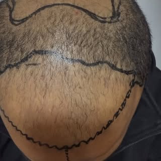 No filters, no gimmicks – just pure transformation in front of your eyes. 👀✨#hairtransplant #lokant