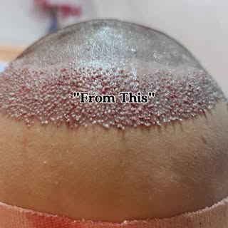 Hair Transplant requires not only precision and expertise but also a lot of patience #hairtransplant