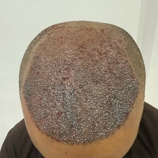 New day ... New case #hairtransplant #hairtransformation #dermatologist