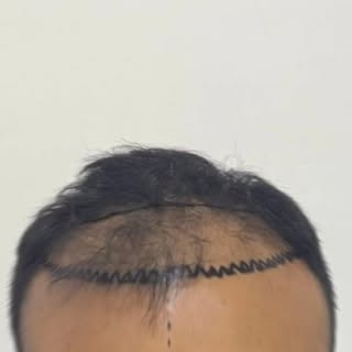 8 months update ... More density in coming months @caraskinclinic
