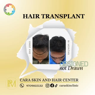 Hair Transplant is a combination of expertise and art. A good hairline is always of prime importance
