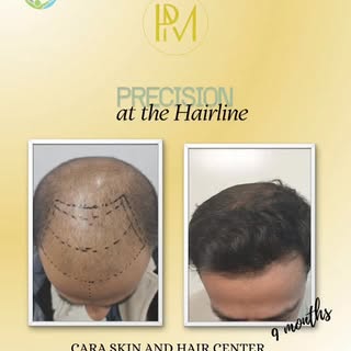 Hair transplant is not just about the number of grafts in a session but also the precision in the tr