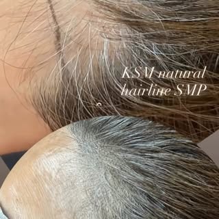 Senior Hairline Camouflage 헤어라인은 아시다시피 가장 보수적인 접근이 필요해요^^ 특히 엠보싱이 강한 시니어  헤어라인 camouflage SMP 인경우, 부