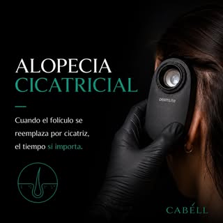La alopecia cicatricial es una condición en la que la inflamación puede destruir de forma permanente